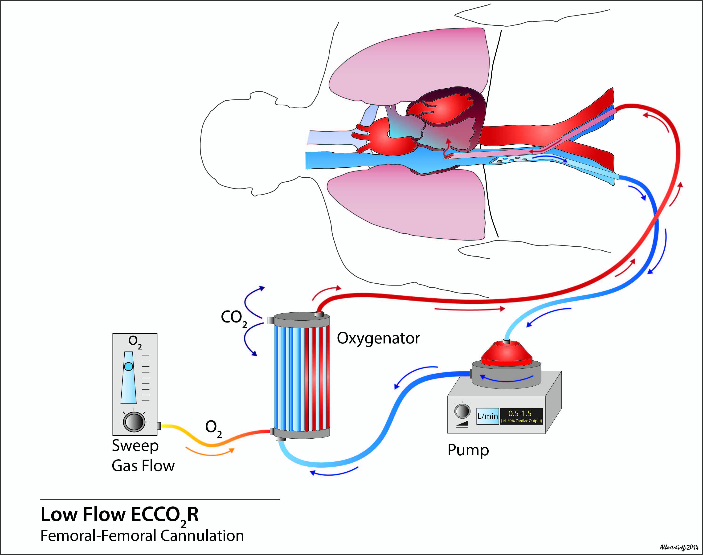 Acute Respiratory Failure Ecls Covid 19 Extracorporeal Co2 Removal